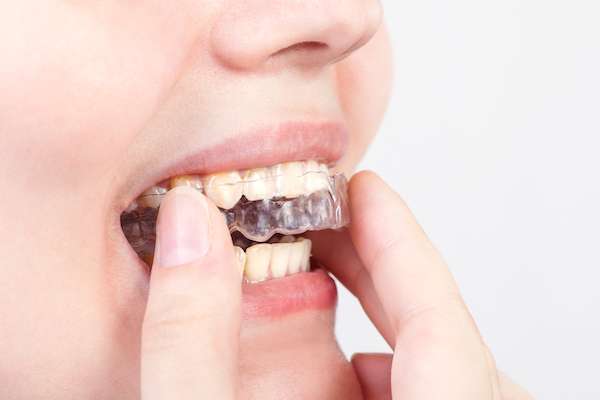 5 Things You May Not Have Known About Clear Braces from Northside Dental Care, PC in Peabody, MA