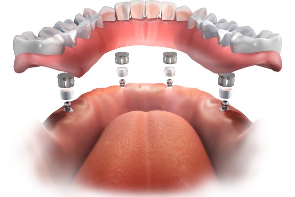 All On 4 Dental Implants Peabody, MA