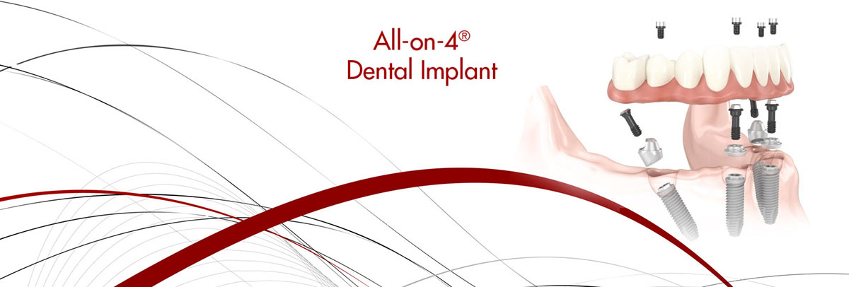 Peabody All-on-4 Dental Implants