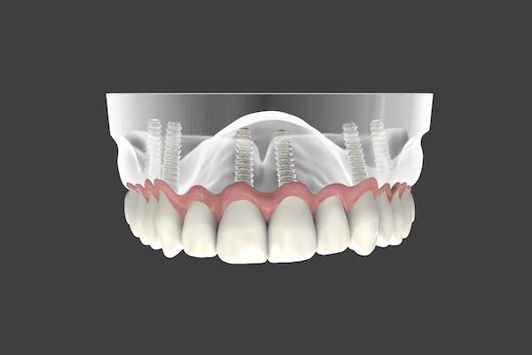 Are Implant Supported Dentures Permanent from Northside Dental Care, PC in Peabody, MA