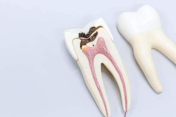 Ask a General Dentist: Is a Tooth Dead After a Root Canal from Northside Dental Care, PC in Peabody, MA