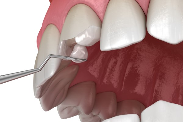 Common Treatments For A Chipped Tooth