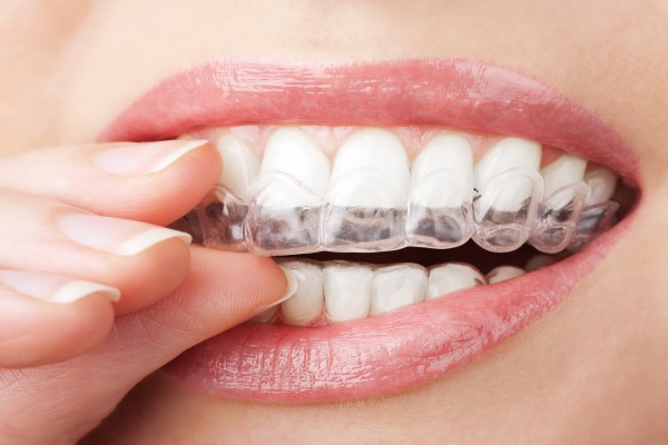 Clear Aligners To Correct Crowded Teeth
