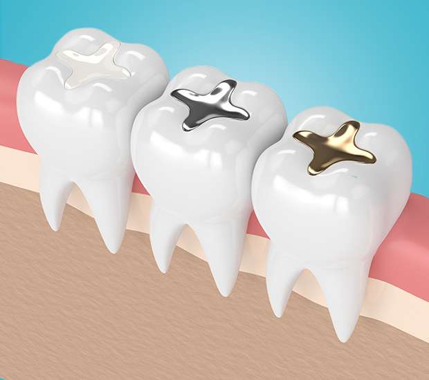 Peabody Tooth Colored Fillings
