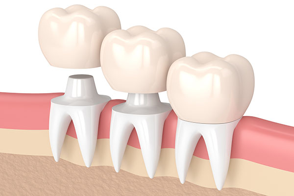 Three Tips to Deal With a Loose Dental Crown from Northside Dental Care, PC in Peabody, MA