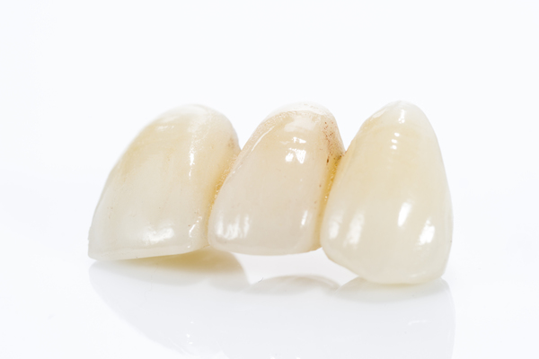 Implant Bridges As A Restorative Option