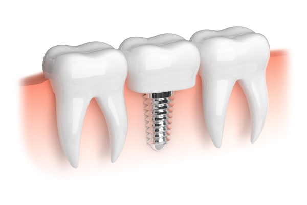 Dental Implant Restoration For Missing Front Teeth