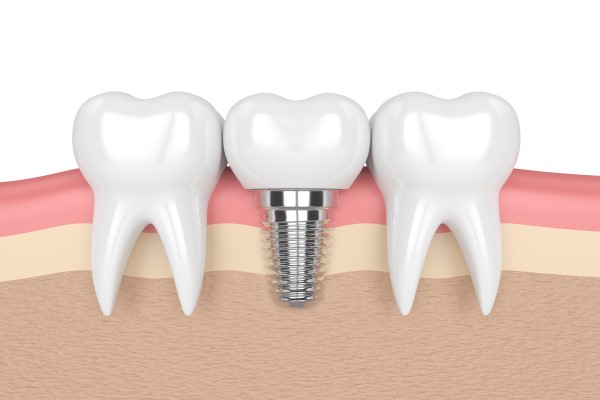 A Dental Implant Restoration To Replace A Damaged Crown