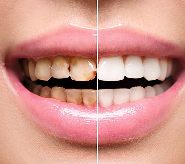 Peabody Dental Implant Restoration