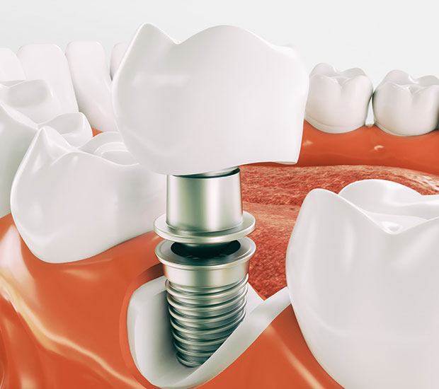 Peabody Dental Implant Restoration