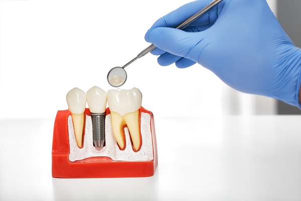 Tips To Prepare For Dental Implants