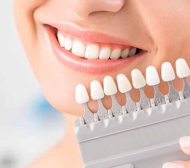 Dental Veneers