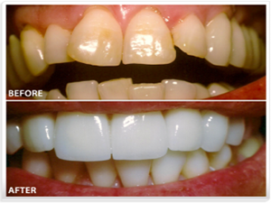 Dental Veneers