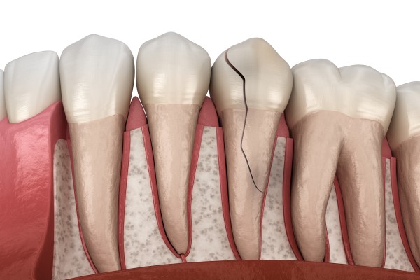 What To Do With A Cracked Tooth