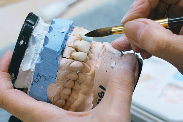 Full Mouth Reconstruction: Restoring Confidence And Long Term Oral Health