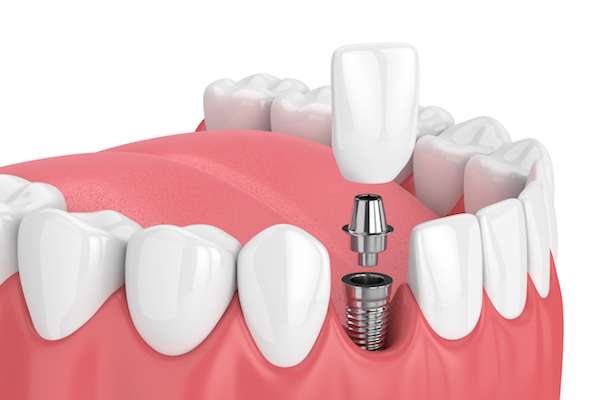 How Painful is Dental Implant Surgery from Northside Dental Care, PC in Peabody, MA