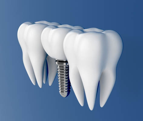 Things To Know About Dental Implants