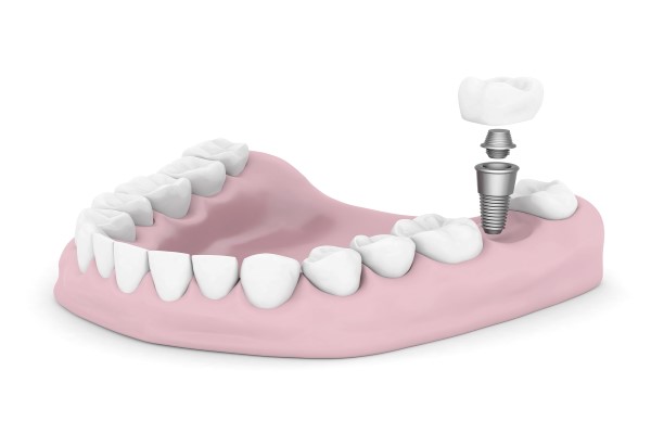 All About Implant Dentistry For A Single Tooth Replacement