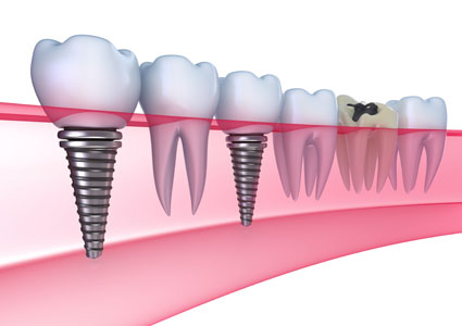 Implant Dentist