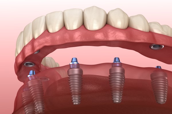 Implant Supported Dentures Peabody, MA