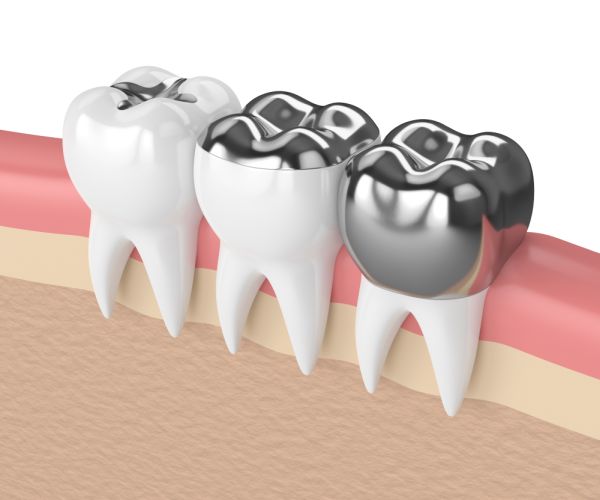 Are Metal Tooth Fillings Dangerous to Health?