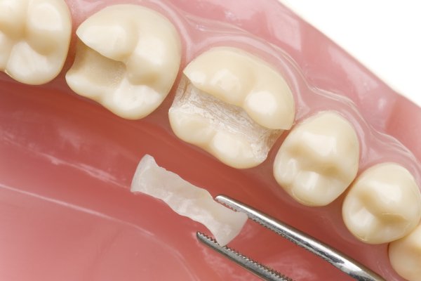 Common Questions About Amalgam Fillings