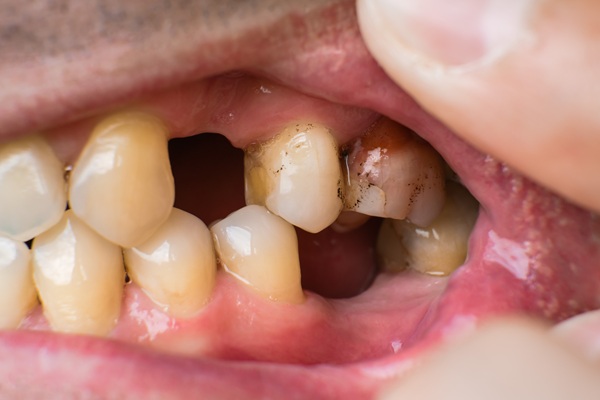 Missing Tooth Dilemmas: Why Immediate Action Protects Oral Health