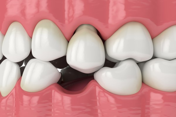 Reasons That A Missing Tooth Needs To Be Replaced