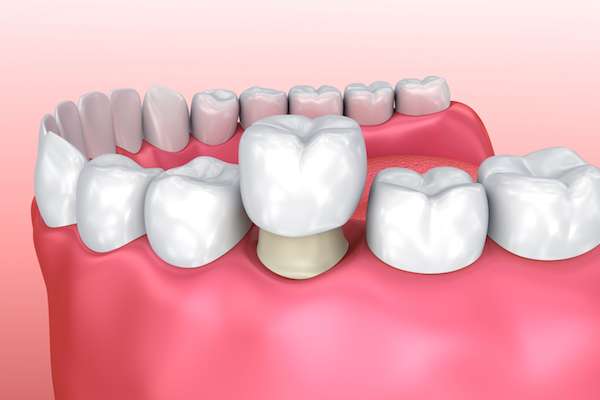Permanent Dental Crowns vs. Temporary: Is There a Difference from Northside Dental Care, PC in Peabody, MA