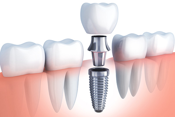 Questions to Ask Your Implant Dentist from Northside Dental Care, PC in Peabody, MA