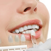 service-dental-veneers-and-dental-laminates