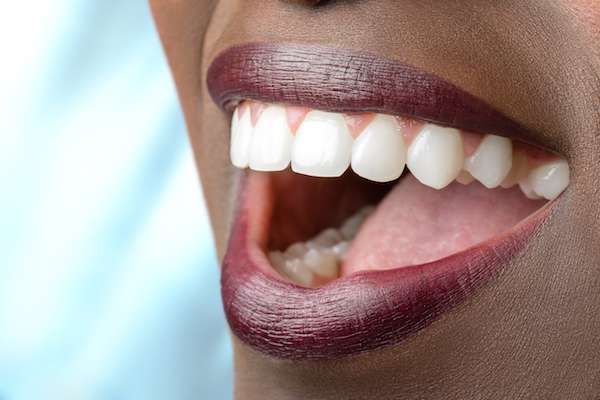 Routine Dental Care: What Are Tooth Colored Fillings from Northside Dental Care, PC in Peabody, MA