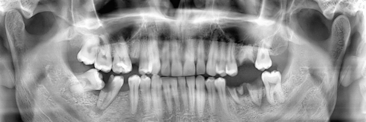Peabody Wisdom Teeth Extraction